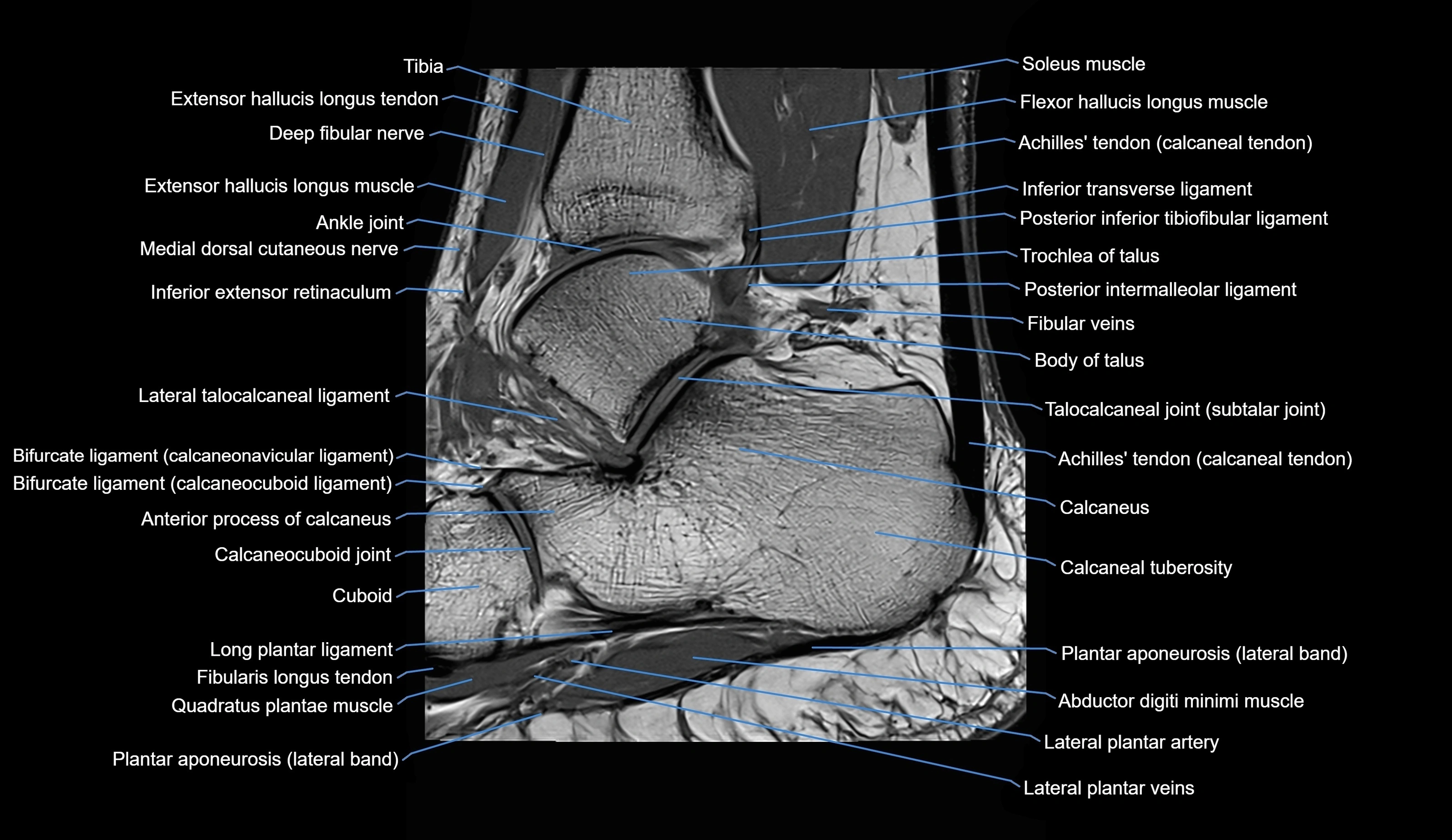 MRI Ankle sagittal cross sectional anatomy 3T  radiology  image-img-00001-00022.webp